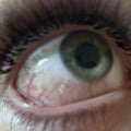 Do Eyelash Extensions Cause Chemical Burns?