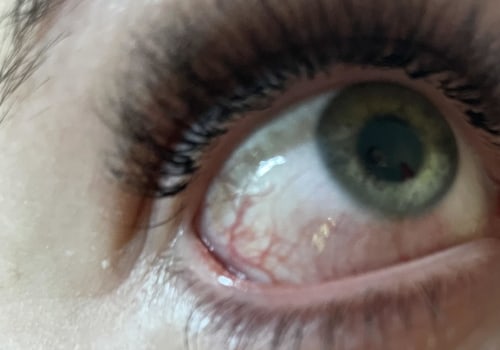 Do Eyelash Extensions Cause Chemical Burns?