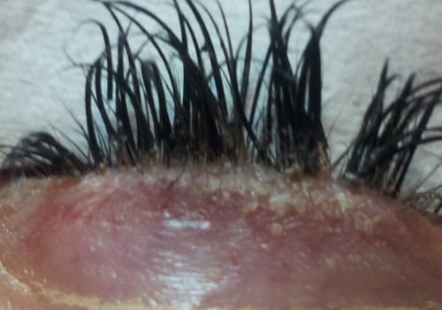 When is the Right Time to Get Eyelash Extensions Removed?