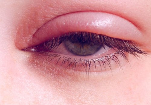What are the Side Effects of Lash Boost?